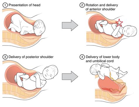 alarm shoulder dystocia|shoulder dystocia newborn delivery.